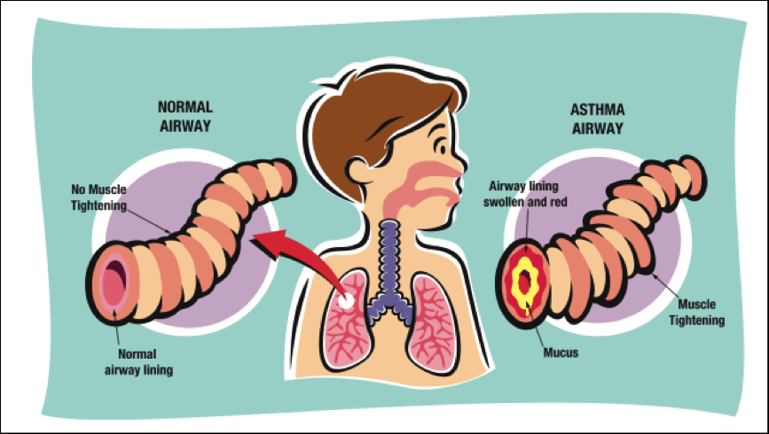 Pediatrics In Dubai | Treating Your Child’s Asthma | MMC